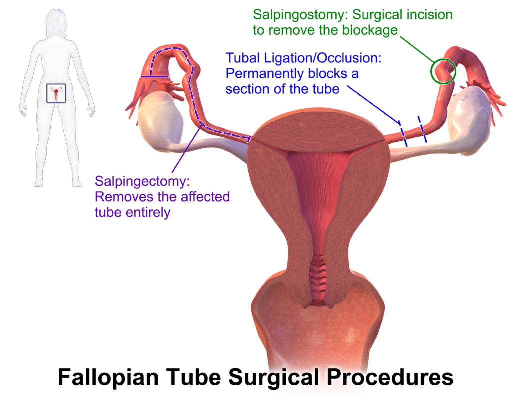 image 001 2 <strong>Advantage and Disadvantage of IVF : What You Need to Know Before </strong>