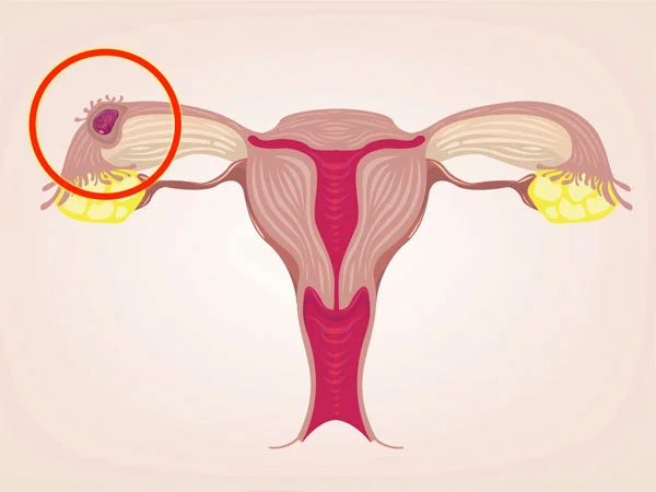 Ectopic Pregnancy Ectopic Pregnancy