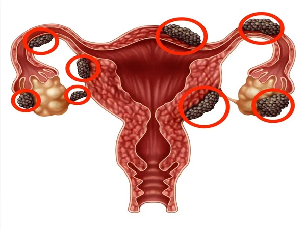 Endometriosis Endometriosis