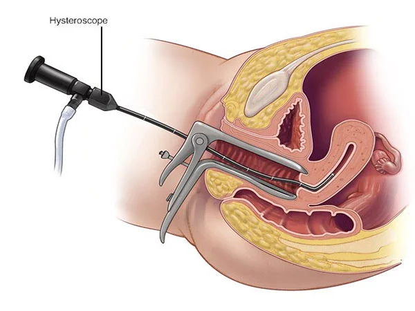 Hysteroscopic Surgeries <strong>Hysteroscopic Surgery</strong>