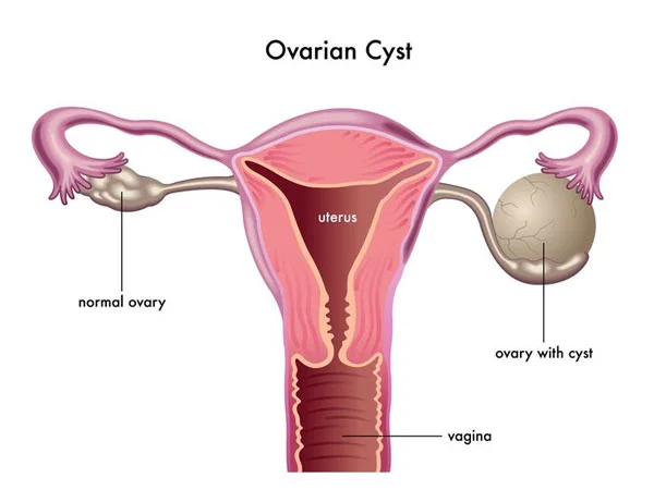 Ovarian Cyst <strong>Ovarian Cyst</strong>