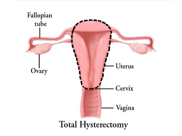 hysterectomy <strong>Total Laparoscopic Hysterectomy</strong>