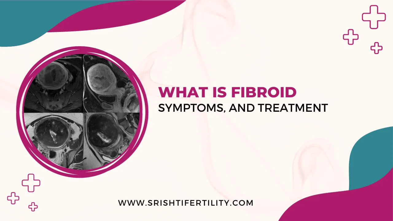What is Fibroid – Symptoms, and Treatment