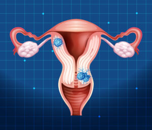 Bulky Uterus – Causes, Symptoms, Treatment and Its Effect on Pregnancy